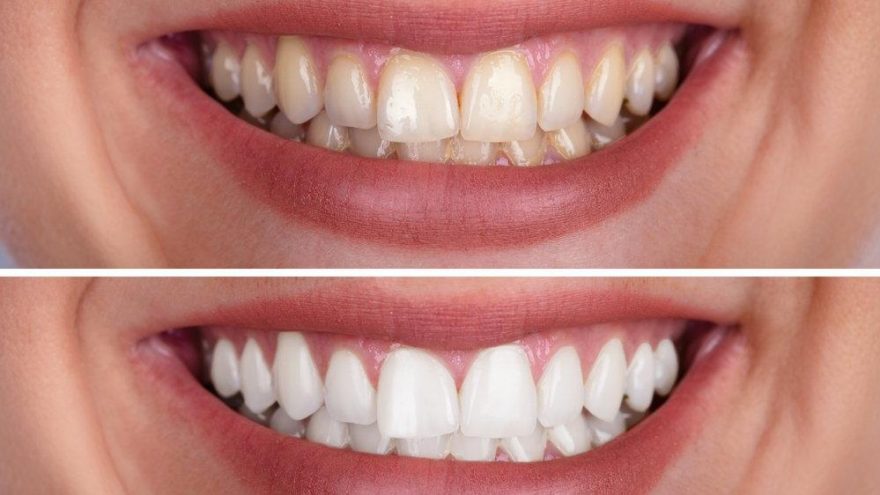  Doğal diş beyazlatma yöntemleri dis-sagligi